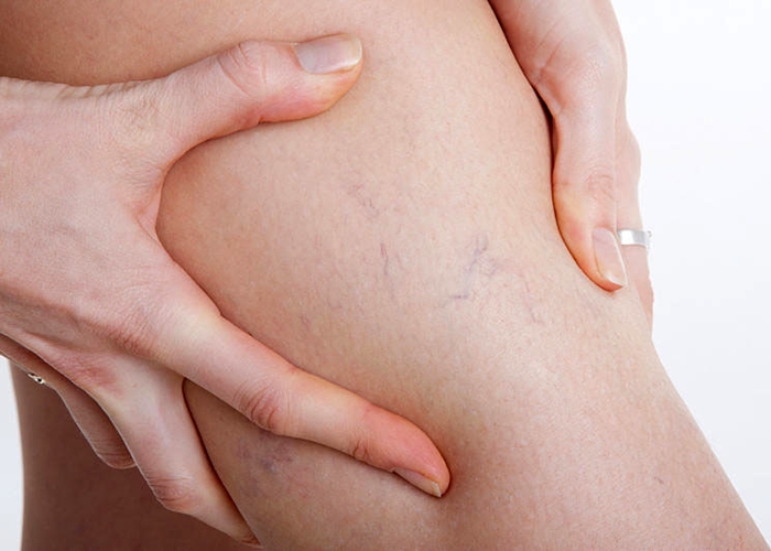Pueden ejercicio con se las varices quitar