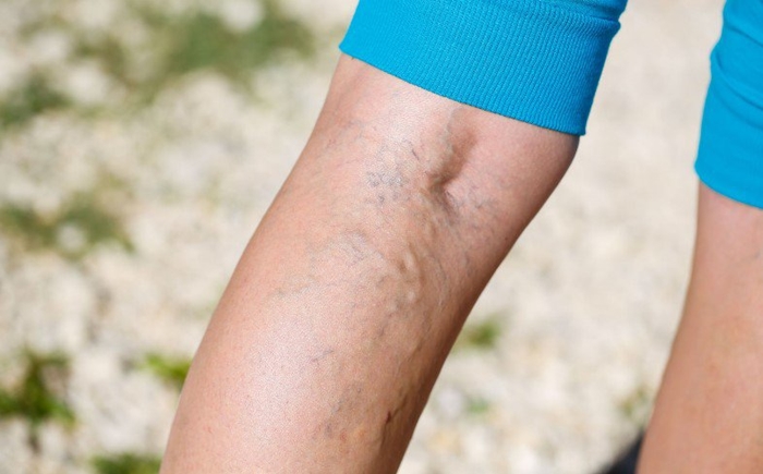 Pueden desaparecer las varices con ejercicio